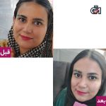 سفید کننده پوست لزل مناسب تا 25 سال